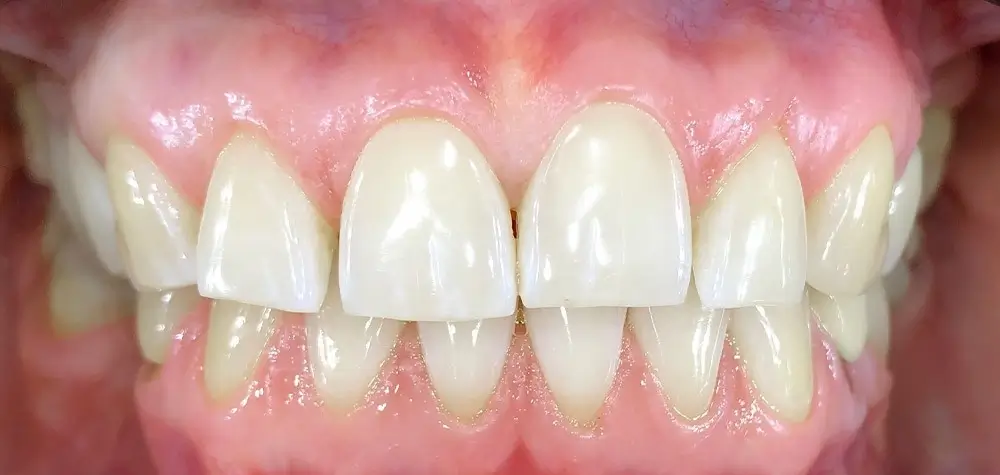 Скученность - Кейс 23 — вид спереди до лечения