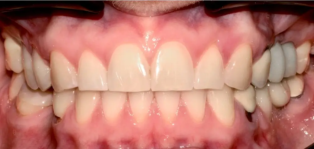 Скученность - Кейс 23 — вид спереди после лечения