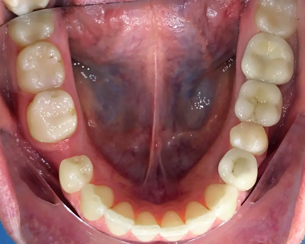 Скученность - Кейс 23 — нижняя челюсть до лечения