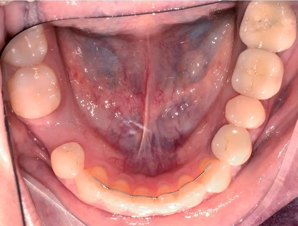 Скученность - Кейс 23 — нижняя челюсть после лечения