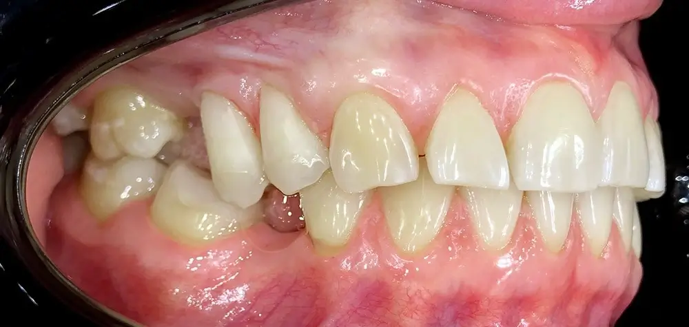 Скученность - Кейс 23 — боковой ракурс до лечения