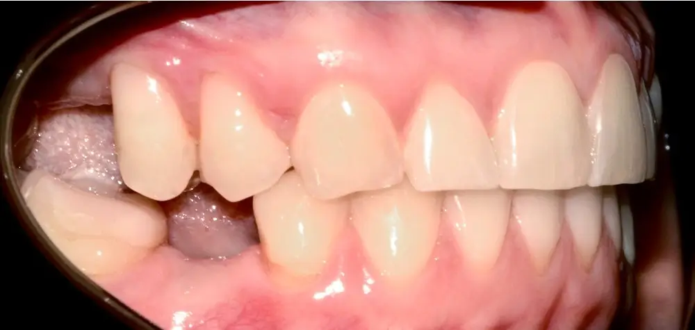 Скученность - Кейс 23 — боковой ракурс после лечения