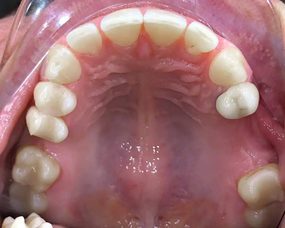 Скученность - Кейс 23 — верхняя челюсть до лечения