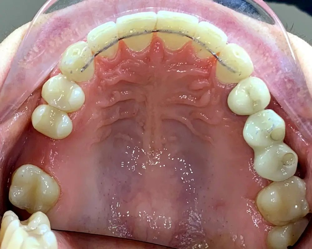 Скученность - Кейс 23 — верхняя челюсть после лечения