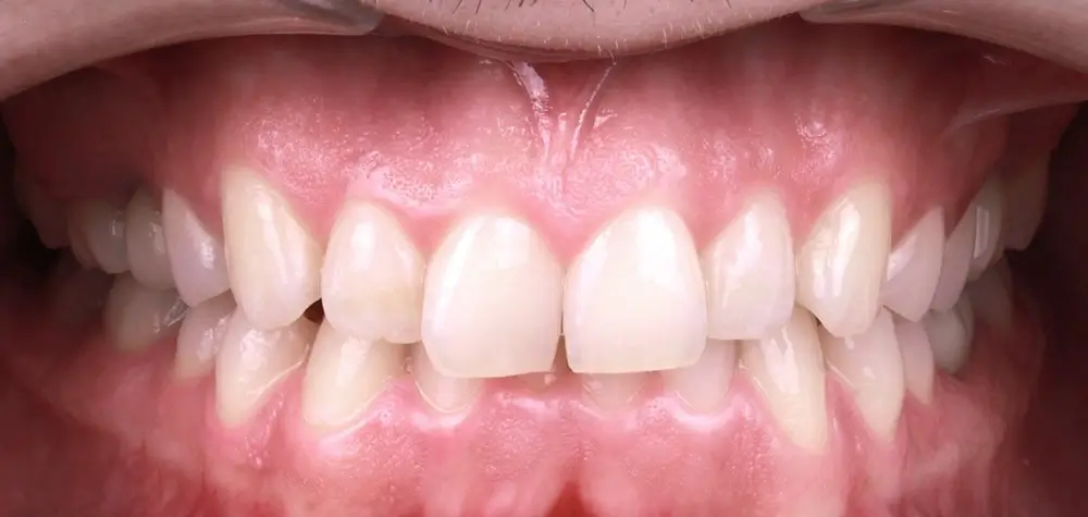 Скученность - Кейс 24 — фронтальный ракурс до лечения