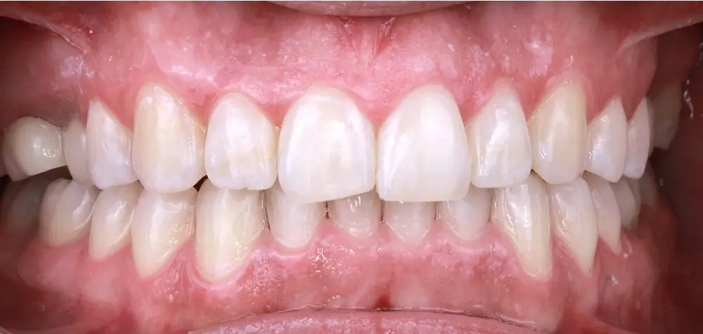 Скученность - Кейс 24 — фронтальный ракурс после лечения