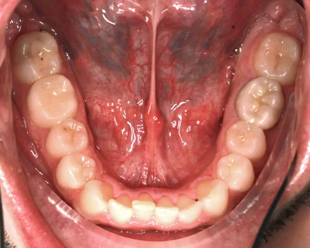 Скученность - Кейс 24 — нижняя челюсть до лечения