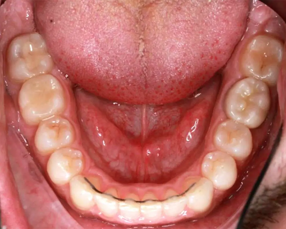 Скученность - Кейс 24 — нижняя челюсть после лечения