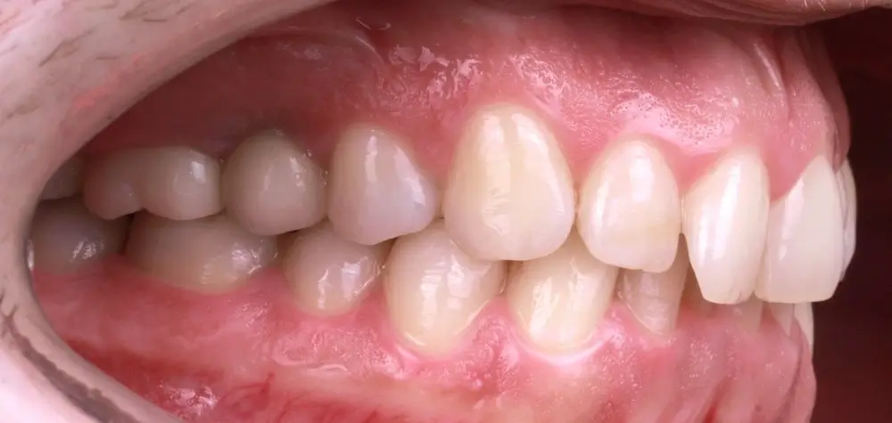 Скученность - Кейс 24 — боковой ракурс до лечения