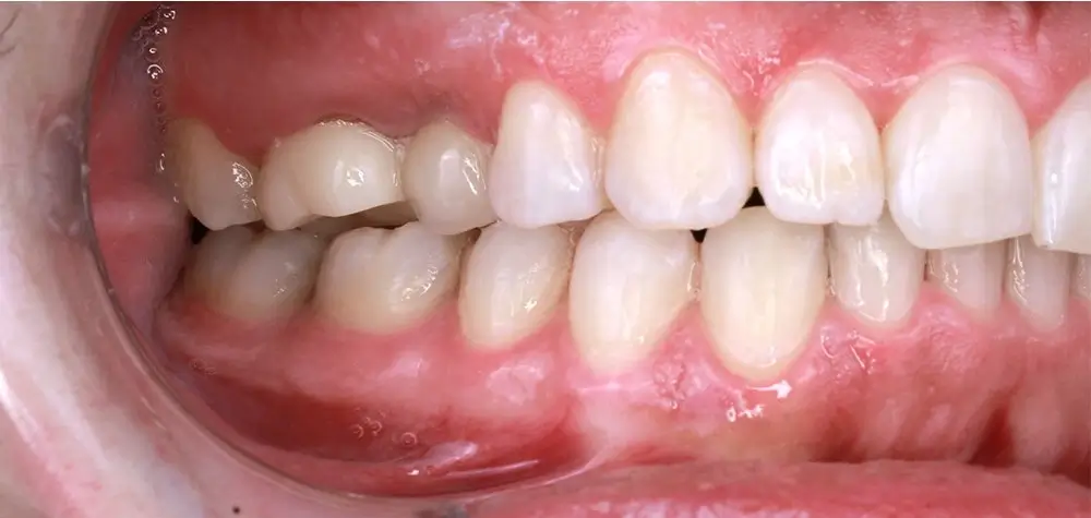 Скученность - Кейс 24 — боковой ракурс после лечения