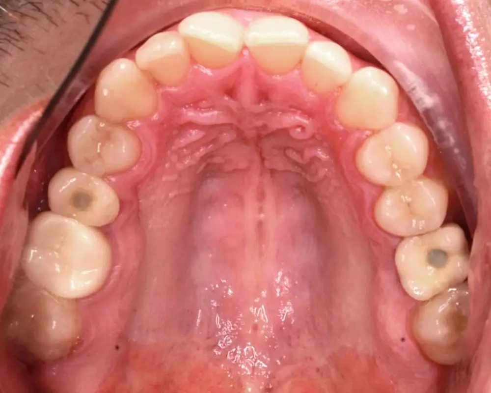 Скученность - Кейс 24 — верхняя челюсть до лечения