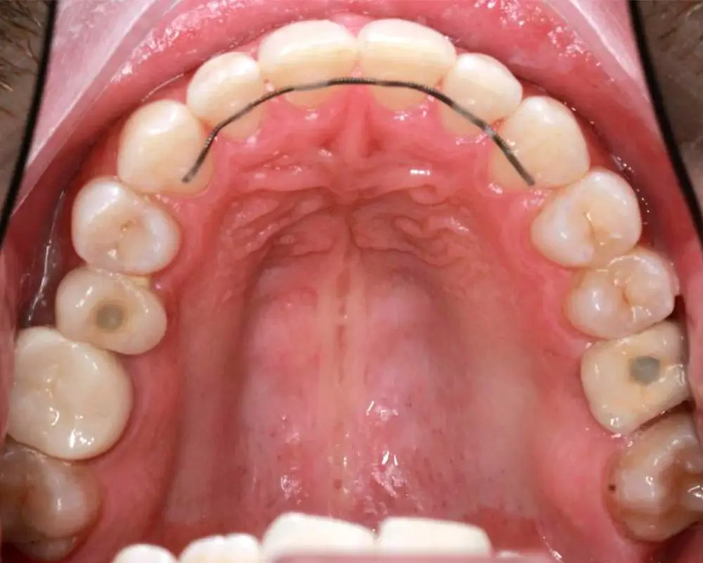 Скученность - Кейс 24 — верхняя челюсть после лечения