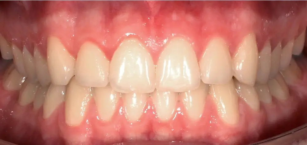 Скученность - Кейс 25 — вид спереди после лечения