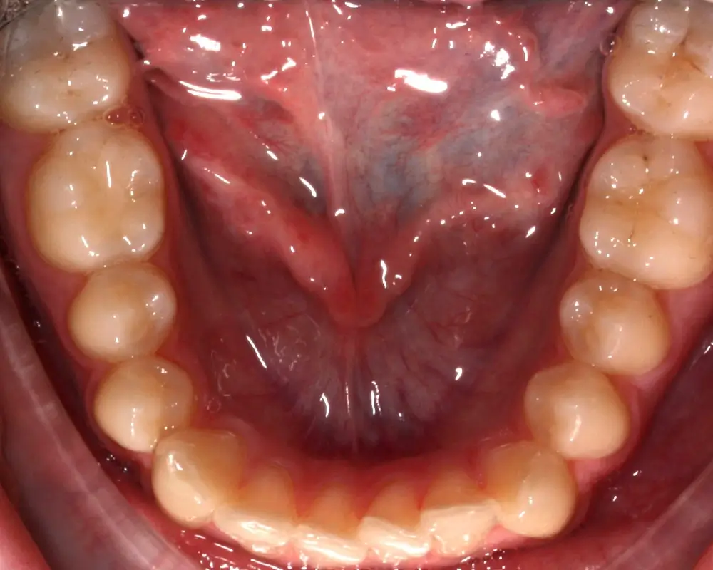 Скученность - Кейс 25 — нижняя челюсть до лечения