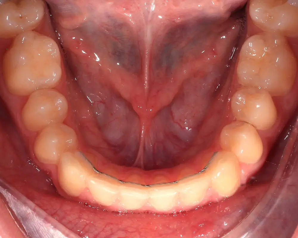 Скученность - Кейс 25 — нижняя челюсть после лечения