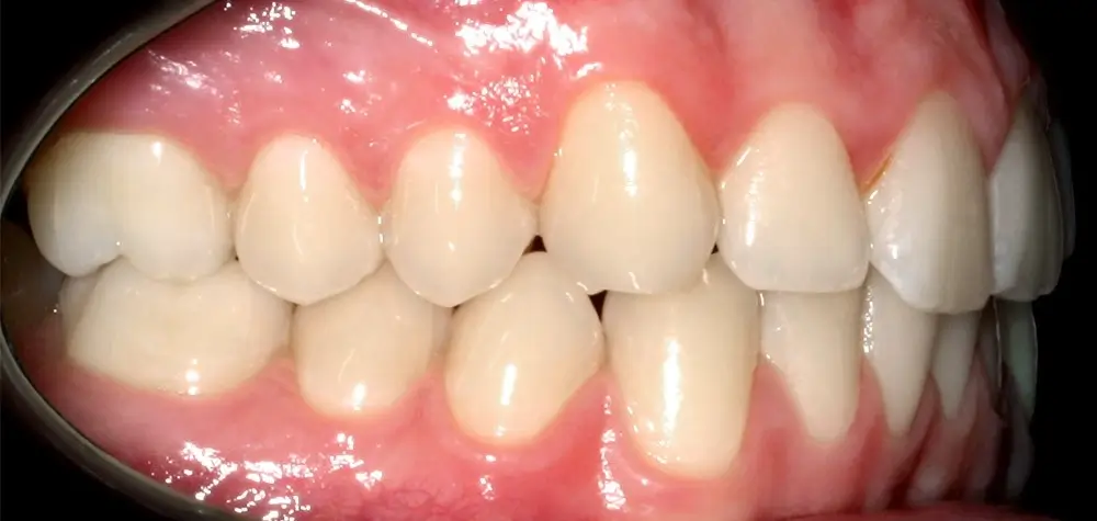 Скученность - Кейс 25 — боковой ракурс до лечения