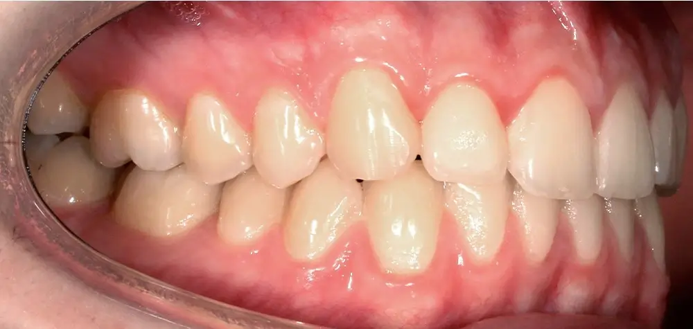 Скученность - Кейс 25 — боковой ракурс после лечения