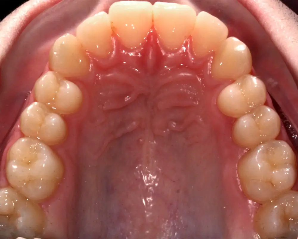 Скученность - Кейс 25 — верхняя челюсть до лечения