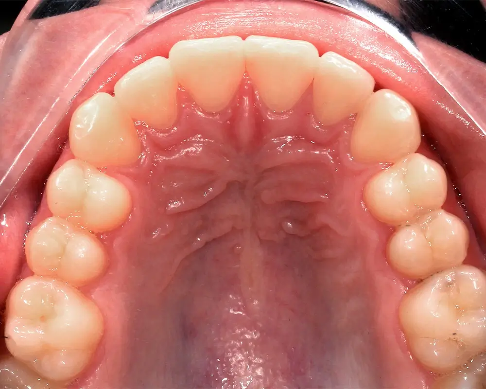 Скученность - Кейс 25 — верхняя челюсть после лечения