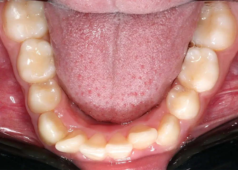 Скученность - Кейс 26 — нижняя челюсть до лечения