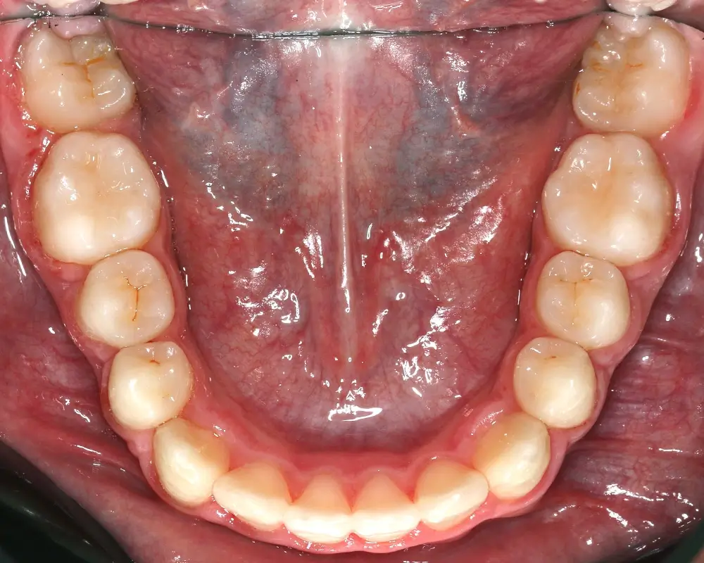 Скученность - Кейс 26 — нижняя челюсть после лечения