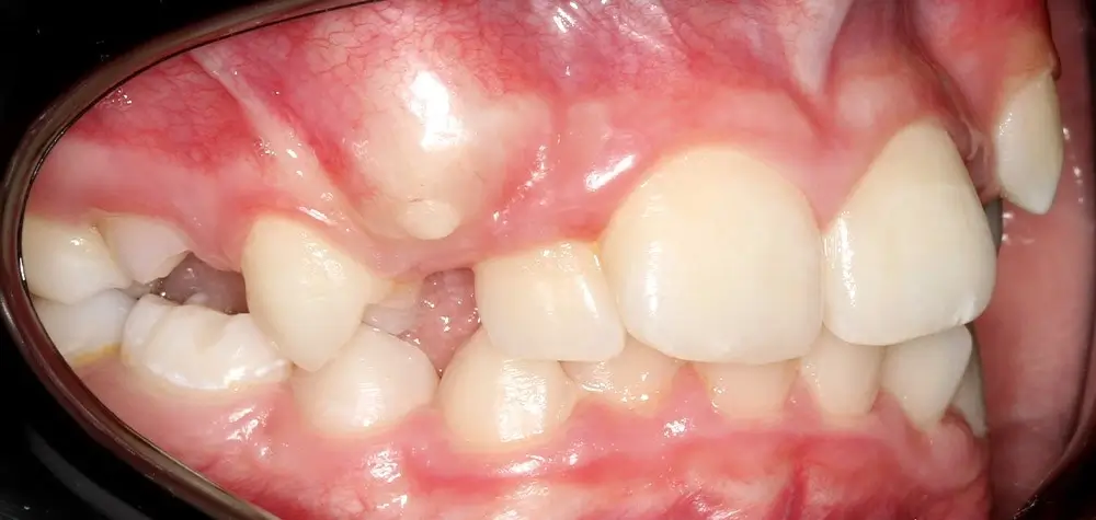 Скученность - Кейс 26 — боковой ракурс до лечения