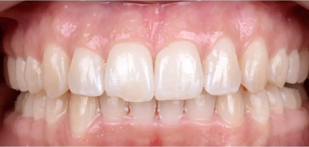 Скученность - Кейс 3 — вид спереди после лечения