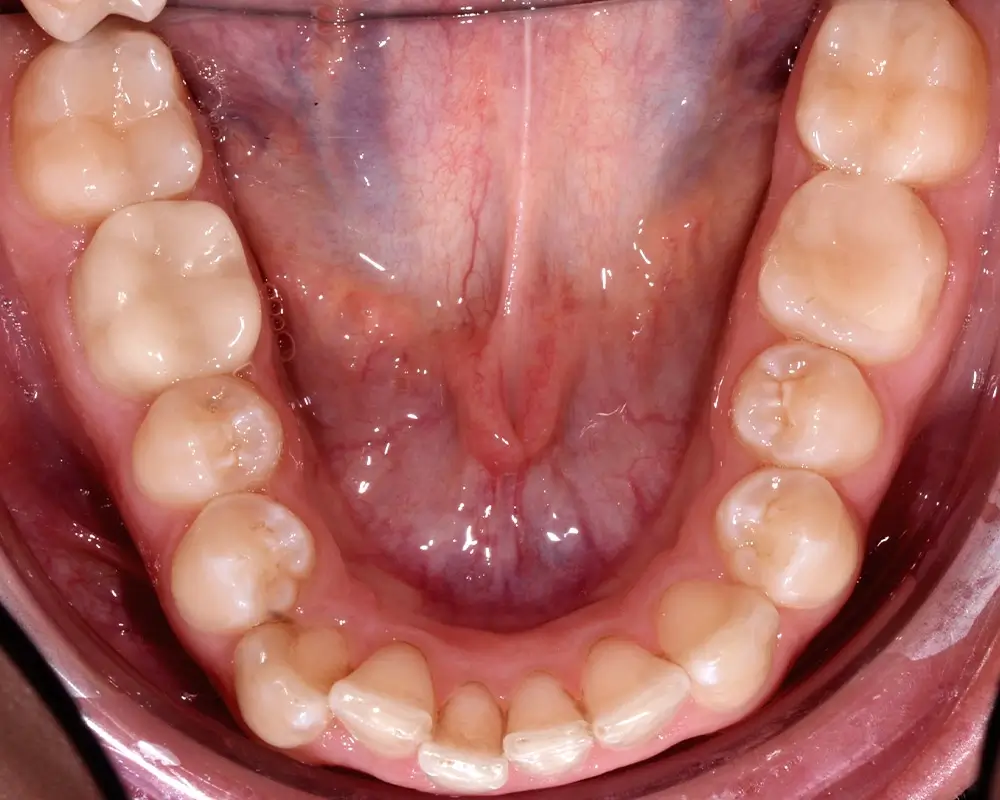 Скученность - Кейс 3 — нижняя челюсть до лечения