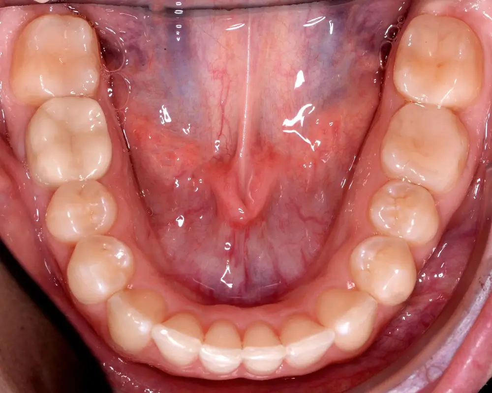 Скученность - Кейс 3 — нижняя челюсть после лечения