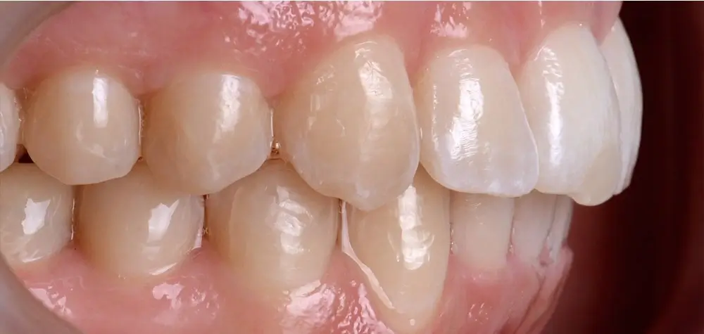 Скученность - Кейс 3 — боковой ракурс после лечения