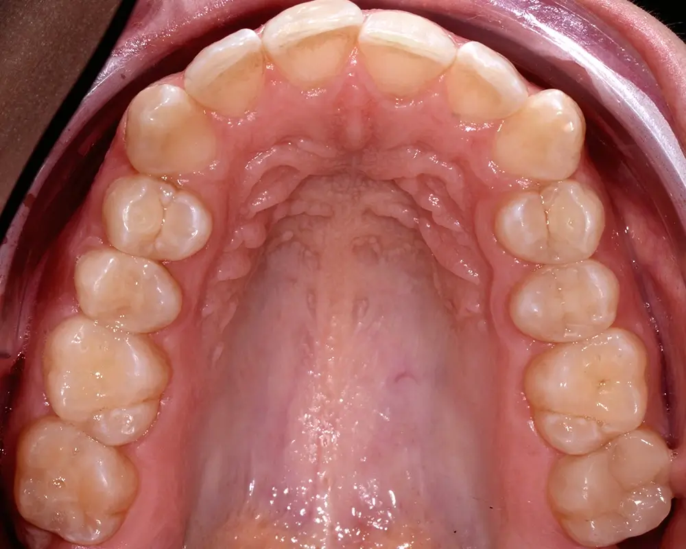 Скученность - Кейс 3 — верхняя челюсть до лечения