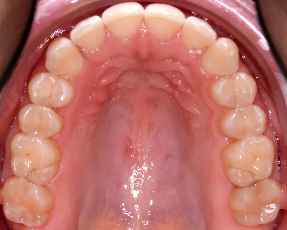 Скученность - Кейс 3 — верхняя челюсть после лечения