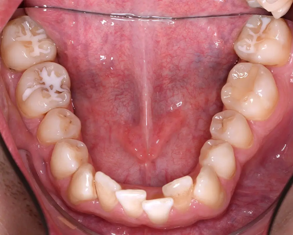 Скученность - Кейс 4 — нижняя челюсть до лечения