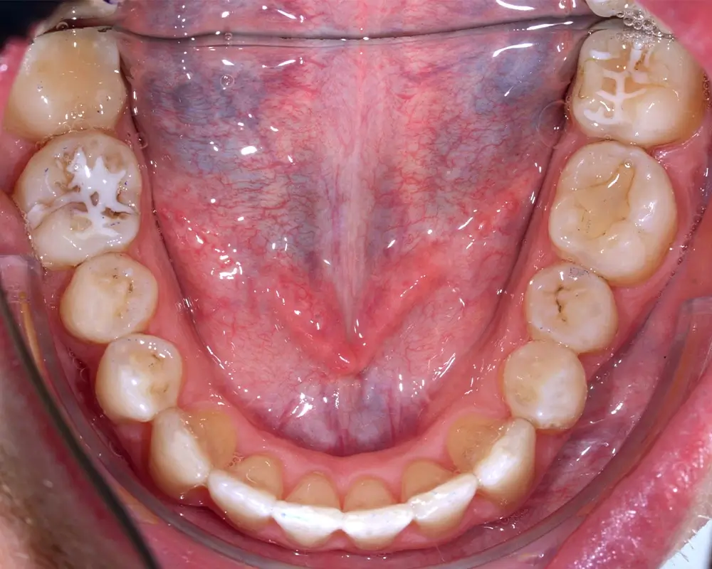 Скученность - Кейс 4 — нижняя челюсть после лечения