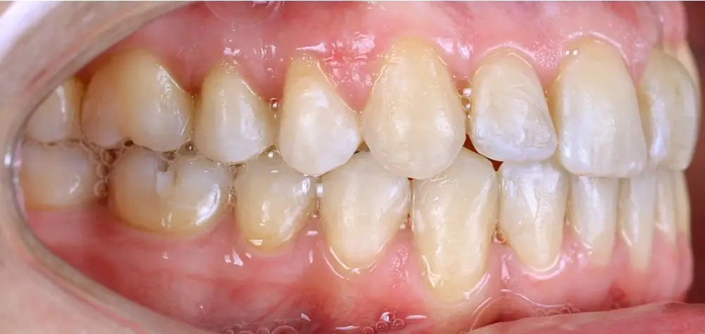 Скученность - Кейс 4 — боковой ракурс после лечения