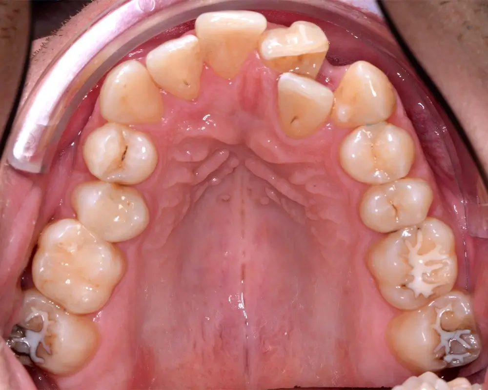 Скученность - Кейс 4 — верхняя челюсть до лечения