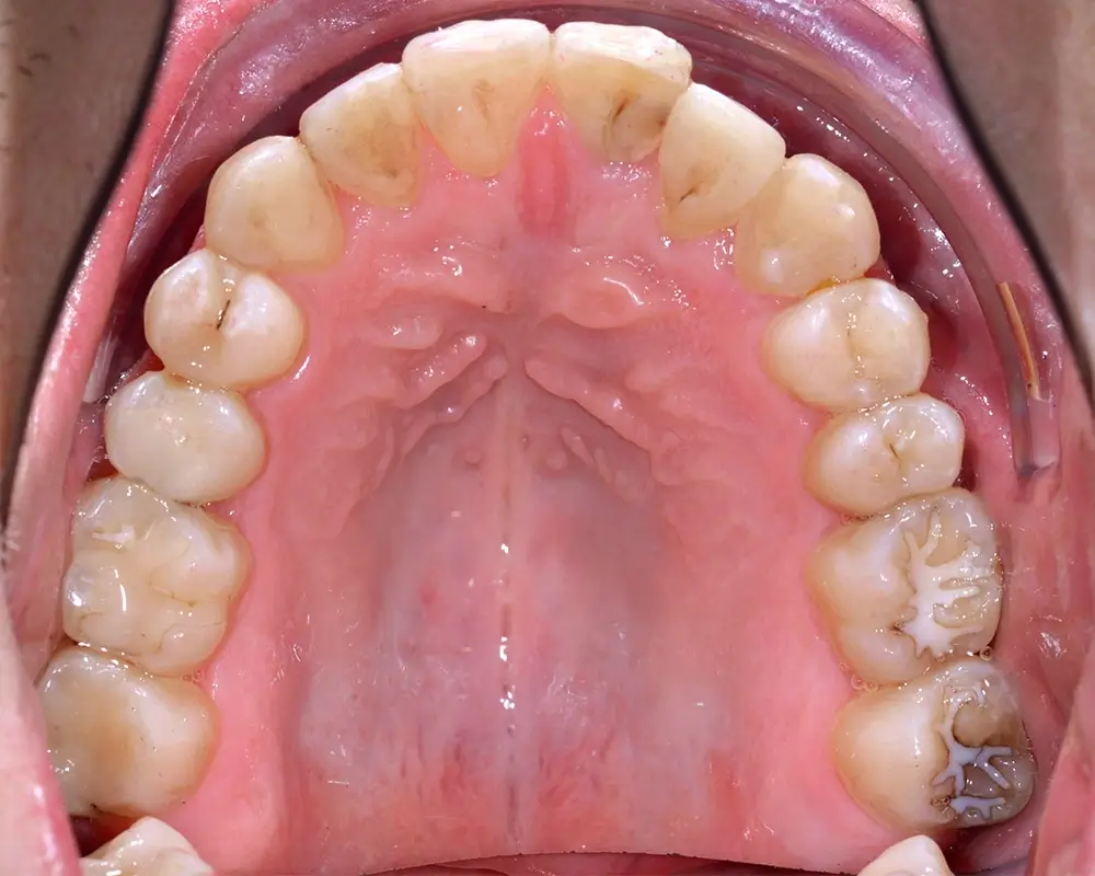 Скученность - Кейс 4 — верхняя челюсть после лечения