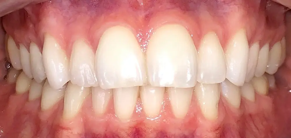 Скученность - Кейс 5 — вид спереди до лечения