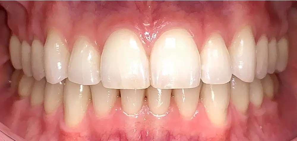 Скученность - Кейс 5 — вид спереди после лечения