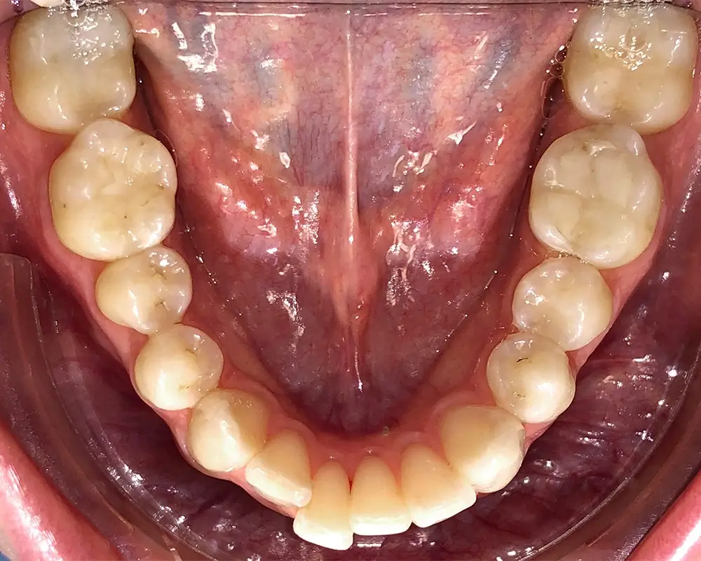 Скученность - Кейс 5 — нижняя челюсть до лечения