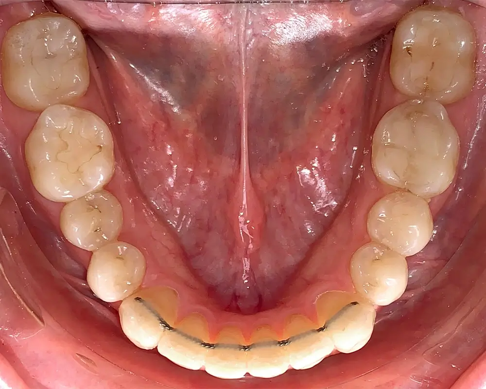 Скученность - Кейс 5 — нижняя челюсть после лечения