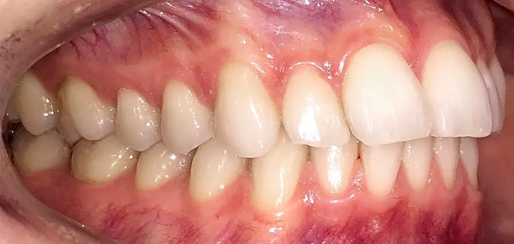 Скученность - Кейс 5 — боковой ракурс до лечения