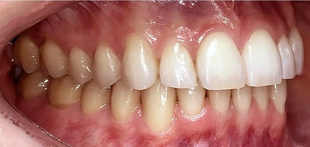 Скученность - Кейс 5 — боковой ракурс после лечения