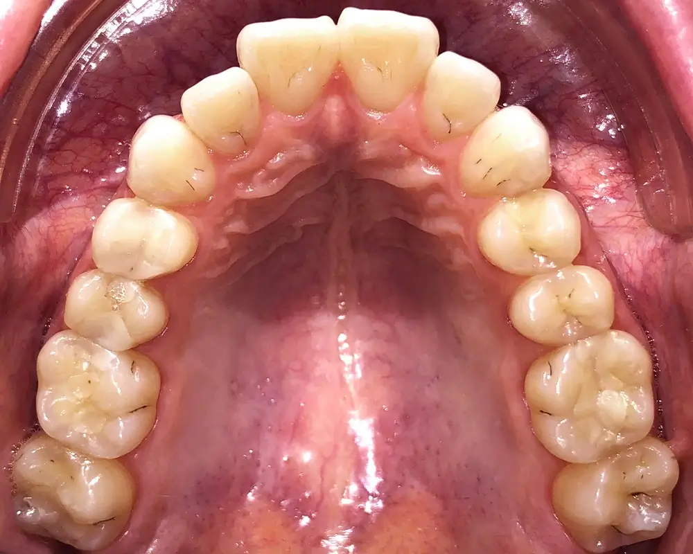Скученность - Кейс 5 — верхняя челюсть до лечения