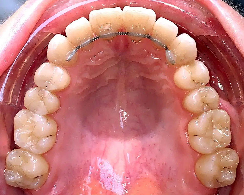 Скученность - Кейс 5 — верхняя челюсть после лечения