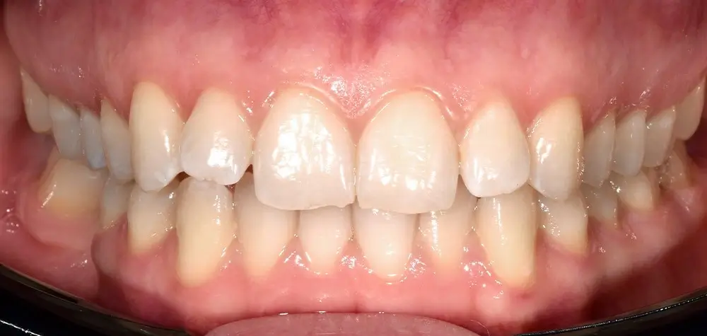 Скученность - Кейс 6 — вид спереди до лечения