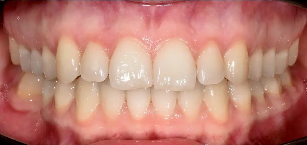 Скученность - Кейс 6 — вид спереди после лечения