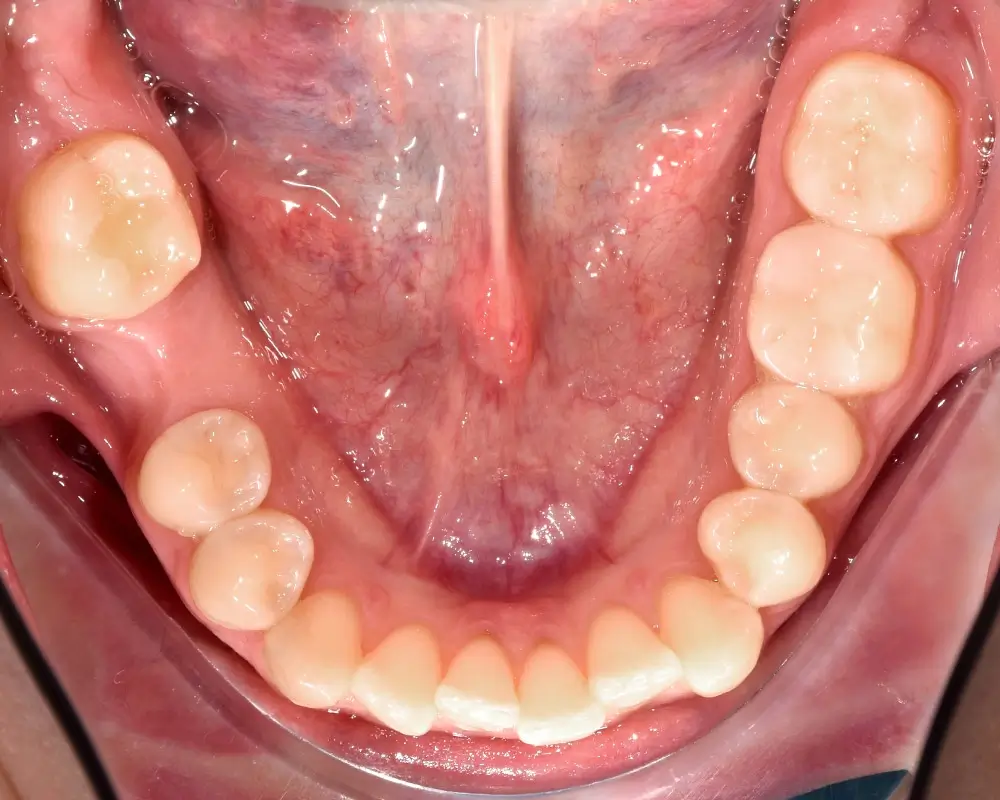 Скученность - Кейс 6 — нижняя челюсть до лечения