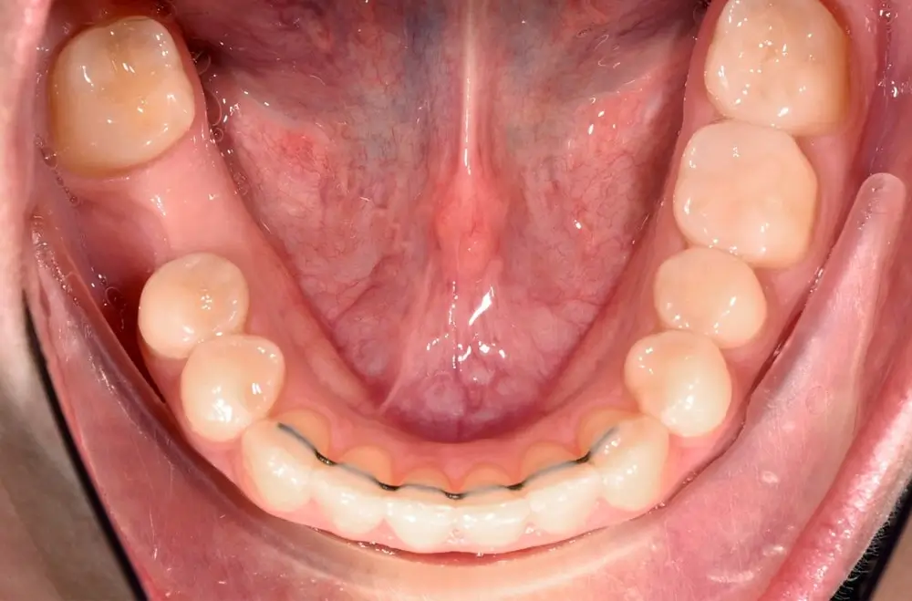 Скученность - Кейс 6 — нижняя челюсть после лечения