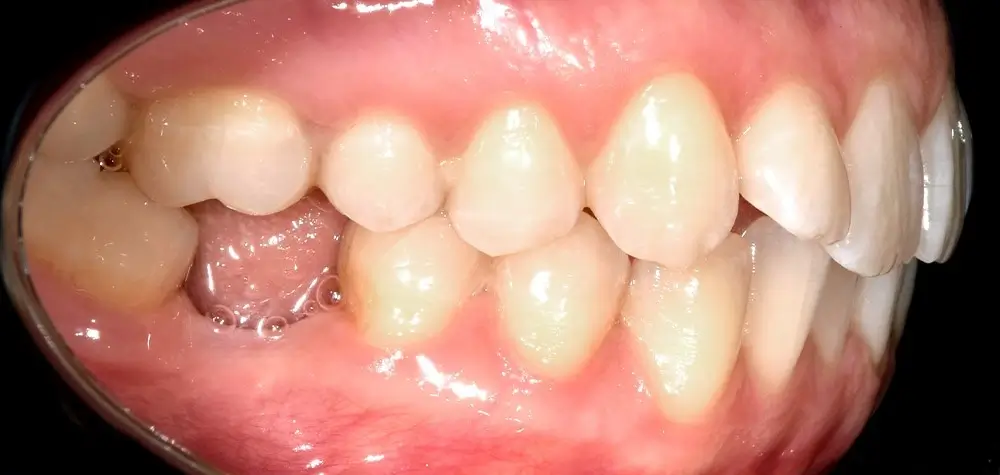 Скученность - Кейс 6 — боковой ракурс до лечения